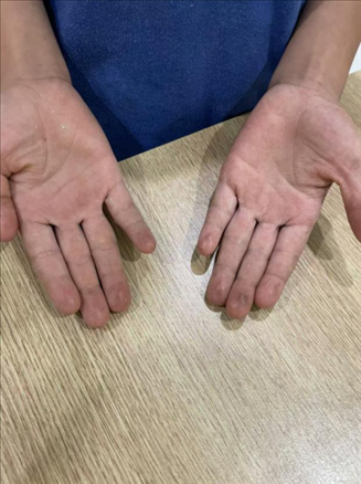 9歲小學(xué)生長(zhǎng)期拍煙卡，手部粗糙長(zhǎng)繭。受訪(fǎng)者供圖
